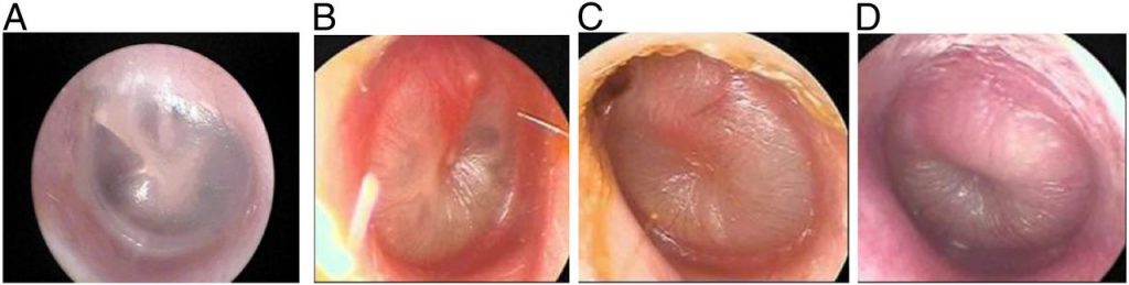 otitis media