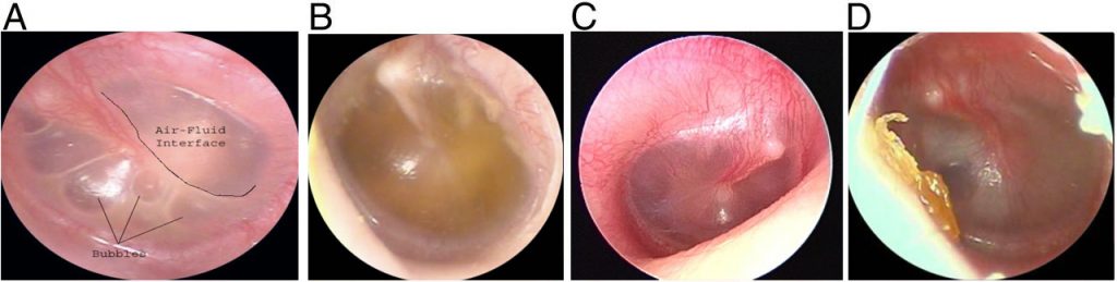 Grommet in the eardrum, otoscope view - Stock Image - C038/5777