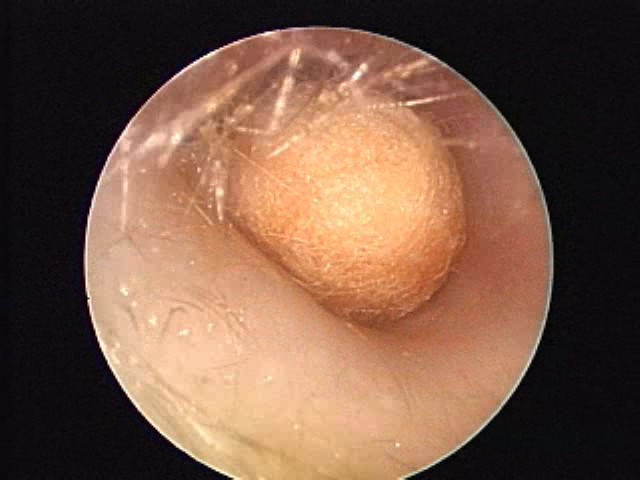 Q tip ear canal